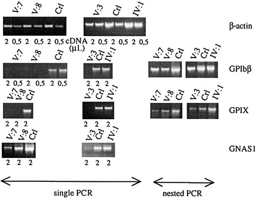 Fig. 4. Platelet glycoprotein mRNA studies. / Semiquantitative RT-PCR analysis of the genes for β-actin, GPIbβ, GPIX, and Gsα (GNAS1) using platelet RNA of affected patients (V:7, V:8, and V:3), obligate carrier (IV:1), and controls (Crl). Starting from the same amount of platelet RNA, patients and controls have comparable levels of β-actin expression. All patients have a very weak expression of the GATA1-regulated genesGPIbβ and GPIX, only showing a visible fragment after performing a nested PCR. Patients also show a weaker signal for the nondirectly GATA1-regulated gene GNAS1.