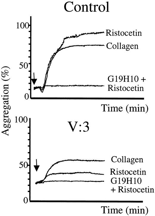 Fig. 7. Functional platelet analysis. / Aggregation tracings of the patient V:3 and control (both 130 000 platelets/μL). Arrows indicate the addition of aggregating agents (collagen or ristocetin) or preincubation (1 minute) with G19H10 antibody.