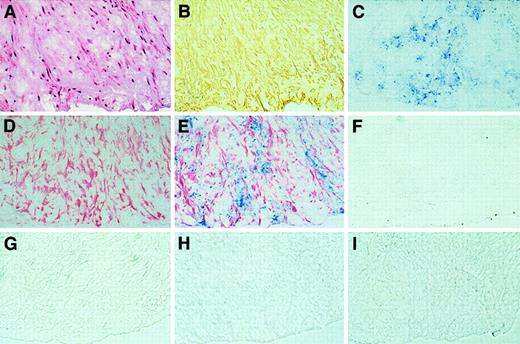 Fig. 9. TFPI and apo(a) immunostaining coexist in human coronary atherosclerotic plaque. / (A) Photomicrograph showing hematoxylin and eosin staining of human fibrocellular plaque obtained by coronary atherectomy (objective × 20). (B) Adjacent section showing SMC α-actin staining (peroxidase with DAB substrate, objective × 20). (C) Adjacent section showing apo(a) immunostaining (alkaline phosphatase with vector blue, objective × 20). (D) Adjacent section showing TFPI immunostaining (alkaline phosphatase with fast-red substrate, objective × 20). (E) Adjacent section showing double immunostaining of TFPI (red) and apo(a) (blue) (objective × 20). (F) Adjacent section showing lack of staining by mouse anti-PLG antibody (objective × 20). (G-I) Adjacent sections showing lack of staining by isotype-matched mouse, rabbit, and goat IgG control antibodies (objective × 20).