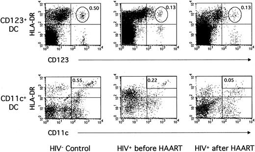 Fig. 2. Blood CD123+ and CD11c+ DCs in one noninfected donor and in one patient during primary infection before and after 12 months of HAART. / PBMCs from one HIV-noninfected control donor and one HIV-infected patient (patient no. 2) before and after HAART were labeled as in Figure 1.