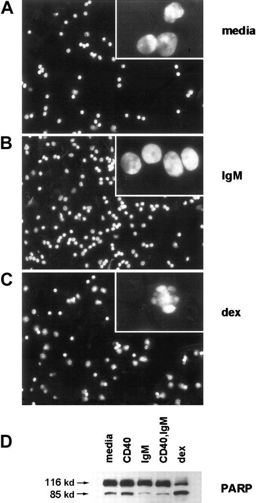 Fig. 2. sIgM engagement inhibits characteristic morphologic features of apoptosis, such as nuclear condensation and plasma membrane blebbing, and inhibits caspase activity in CLL cells. / (A-C) Stimulated CLL cells were evaluated by fluorescence microscopy after staining with DAPI. Low-power micrographs (original magnification 20x) with representative fields and high-power micrographs (insets, original magnification 100x) are included. (D) Cleavage of the broad caspase substrate PARP was determined by western blot analyses. The PARP proform (116 kd) and cleavage product (85 kd) are indicated by arrows.