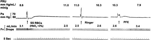 Fig. 1. Example of the effect of PFE on hemodynamic parameters in a PAF-treated mesocecum vasculature after SS RBC-induced obstruction. / A bolus of deoxygenated SS RBCs (Hct 30 in autologous plasma, 0.25 mL; HbO2 < 3%), delivered at an arterial pressure (Pa) of 60 mm Hg, caused a transient rise in Pa and venous outflow (Fv). After the passage of bolus, trapped SS RBCs resulted in only partial recovery of PRU compared with pre-SS baseline value (11.0 vs 8.6 mm Hg/mL per min/g). Next, the infusion of oxygenated Ringer–albumin solution (0.3 mL) caused a slight decrease in PRU from 11.0 to 10.3 mm Hg/mL per min/g. In contrast, a subsequent infusion of oxygenated PFE was followed by recovery PRU to the baseline (pre-SS) value. The PRU decrease was accompanied by complete dislodgement of trapped sickled RBCs from some partially obstructed vessels.