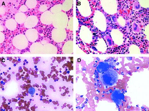Fig. 2. Bone marrow megakaryocytes were decreased in subjects with anti-TPO antibody. / Bone marrow biopsies (A,B) and aspirates (C,D) were examined at an original magnification of × 50 in subject no. 2 (A,C) and in a patient with ITP (B,D).