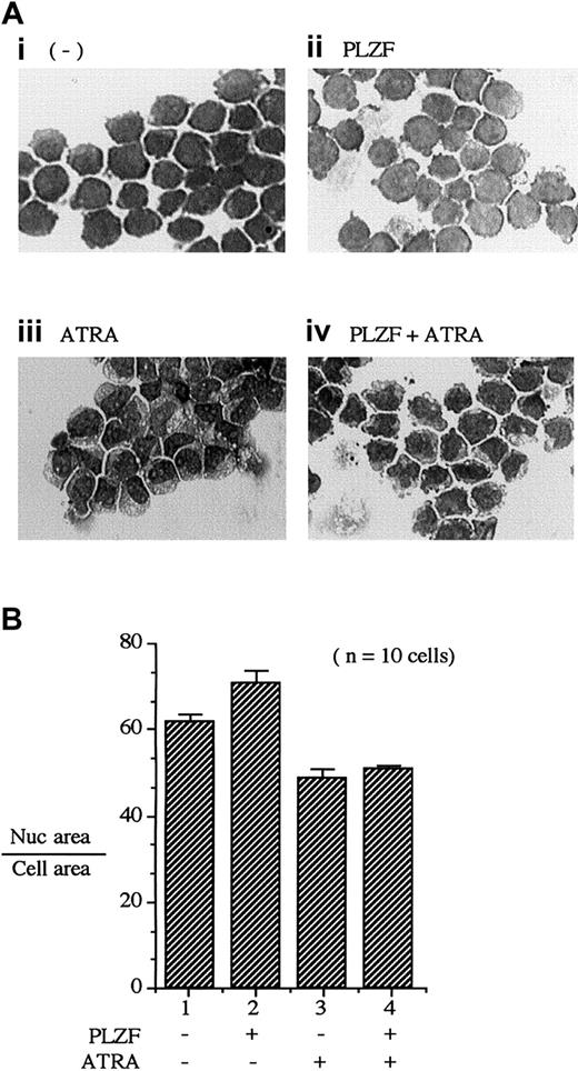 Fig. 8. PLZF expression fails to block morphologic changes induced by ATRA. / Morphometric analysis was done as described in the legend to Figure 7. In this case, however, U937-PLZF45 cells were treated with ATRA (10−6 M) for 48 hours. (A) Giemsa staining of PLZF45 cells with the indicated treatments. Original magnifications × 200. (B) Quantitation of nuclear area as a percentage of total-cell area. The x-axis numbers in panel B correspond to the panel numbers in panel A.
