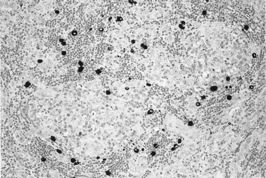 Fig. 1. KSHV v–IL-6 expression in a lymph node of the patient with multicentric Castleman disease. / MCD lymph node section showing KSHV v–IL-6 expression (black) restricted to lymphocytes in the mantle zone of lymphoid follicles.