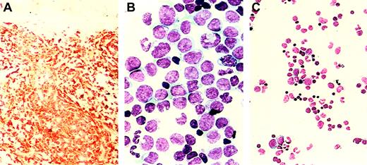 Fig. 1. Erythropoietin-dependent acute monoblastic leukemia. / Histopathology. Skin biopsy showing infiltration by monoblasts staining with lysozyme (panel A, × 50 magnification) and bone marrow aspirate smear showing acute monoblastic leukemia (panel B, × 200 magnification), both during EPO therapy. Bone marrow aspirate smear showing the absence of leukemia 3 weeks after the discontinuation of EPO therapy (panel C, × 50 magnification).