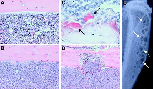 Fig. 2. The effect of 5T2MM cells on the development of bone disease in C57BL/KaLwRijHsd mice. / (A) Histologic section of the tibia from a control animal showing cortical bone and the presence of normal marrow. Original magnification × 20. (B) Histologic section of the tibia from a 5T2MM-bearing animal showing cortical bone and demonstrating the complete replacement of normal marrow by 5T2MM cells. Original magnification × 20. (C) Section reacted for TRAP activity showing the presence of 5T2MM cells found closely associated with TRAP-positive osteoclasts (arrows) lining the bone surface. Original magnification × 40. (D) Section of the tibia from an animal injected with 5T2MM cells showing resorption through the cortical bone. Original magnification × 10. (E) Radiograph of the tibia of an animal bearing 5T2MM cells showing the presence of lytic bone lesions (arrows).