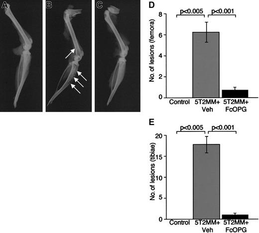 Fig. 3. The effect of Fc-OPG on lytic bone lesions induced by 5T2MM cells. / (A) Radiograph of the tibia and femur from a control, uninjected animal. (B) Radiograph of the tibia and femur of an animal injected with 5T2MM cells and vehicle, showing the presence of lytic lesions (arrows). (C) Radiograph of the tibia and femur of an animal injected with 5T2MM cells and OPG. (D) Number of osteolytic bone lesions in the femora of control animals, animals injected with 5T2MM cells and vehicle, and animals injected with 5T2MM cells and OPG. (E) Number of osteolytic bone lesions in the tibiae of control animals, animals injected with 5T2MM cells and vehicle, and animals injected with 5T2MM cells and OPG.