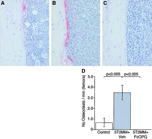 Fig. 5. The effect of OPG on TRAP-positive osteoclast formation in mice bearing 5T2MM myeloma cells. / (A) Section of the tibia from a control, uninjected animal. (B) Section of the tibia from an animal injected with 5T2MM cells and vehicle, showing large numbers of TRAP-positive cells lining the endocortical surface area. (C) Section of the femur from an animal injected with 5T2MM cells and treated with OPG. (D) Osteoclast numbers in the tibiae of control animals, animals injected with 5T2MM cells and vehicle, and animals injected with 5T2MM cells and treated with OPG. Original magnification × 20.