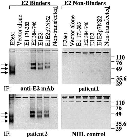Fig. 2. A rescued immunoglobulin from an HCV-associated lymphoma precipitates multiple intracellular forms of the HCV-E2 glycoprotein. / Cell lysates containing each of the HCV glycoproteins were immunoprecipitated with immunoglobulins derived from an anti-E2 mAb (CBH-4G), from the 2 HCV-associated NHL cases, and from a non-HCV NHL control immunoglobulin. Proteins were separated by SDS-PAGE, and blots were probed with an antibody against HCV-E2. Sizes (in kd) of protein markers are indicated on the right, and arrowheads on the left point to the precipitated forms of E2. IP indicates the source of immunoprecipitating immunoglobulin.