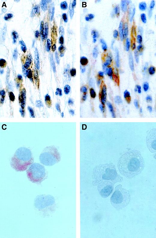 Fig. 2. Detection of CD2 in neoplastic MCs by in situ immunostaining. / (A,B) Immunohistochemical detection of CD2 in BM MCs in a patient with SM. The BM biopsy section was first stained with CD2 mAb AB75 (A), demounted, and then stained with mAb G3 against tryptase (B). As visible, the spindle-shaped tryptase-positive MCs were found to be immunoreactive for CD2. Original magnification approximately × 500. (C,D) Immunocytochemistry of HMC-1 cells. Sorted HMC-1 subsets, ie, CD2+ HMC-1 cells (C) and CD2− HMC-1 cells (D), were spun on cytospin slides and stained with CD2 mAb 6F10.3 as described in the text. Immunocytochemistry confirmed expression of the CD2 protein in the cytoplasm of CD2+ HMC-1 cells and absence of (cytoplasmic) CD2 in the surface CD2− HMC-1 cells. Note granular staining pattern of CD2+ HMC-1 cells. Original magnification approximately × 250.