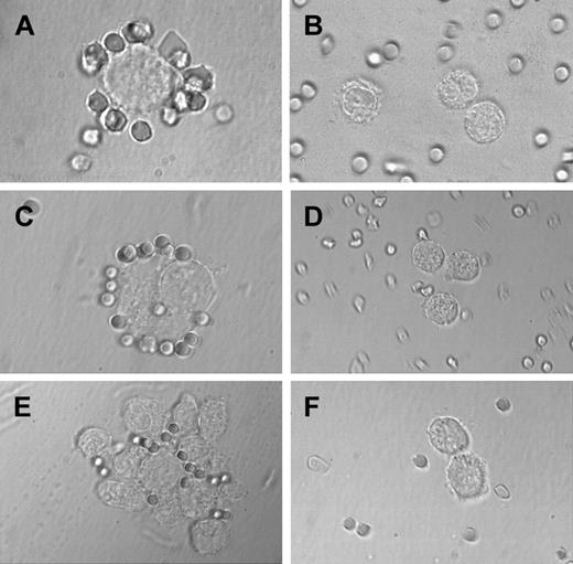 Fig. 6. Sheep erythrocyte rosette formation. / Highly purified BM MCs and HMC-1 cells (CD2+ and CD2− subsets) were incubated with sheep erythrocytes as described in the text. In the patient with SM, MCs were found to form rosettes with sheep erythrocytes (A), whereas no rosette formation was seen in a patient with reactive marrow (B). (C) A typical rosette of sheep erythrocytes on a CD2+ HMC-1 cell. In fact, in the CD2+ HMC-1 cell fraction, many sheep erythrocyte rosettes were found, whereas only few, if any, rosettes were found in the CD2− HMC-1 cell fraction (D). (E) A cluster of HMC-1 cells binding to sheep erythrocytes. In the same experiment, cluster and rosette formation were both inhibited by preincubating HMC-1 cells with the mAb 39C1.5 recognizing the T11-1 epitope of CD2 (F).