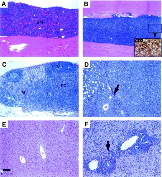 Fig. 4. Histopathology findings. / (A) Control animal recipient of BM cells transduced with parent MSCV vector; H&E stain (100 × magnification) (scale bar: 100 μm). (B)Dll4-overexpressing animal with a diffuse lymphoblastic infiltrate; H&E (10 ×). Inset: closeup of CD3+ T cells, ABC immunostain (400 ×). (C) Mesenteric lymph node from a control mouse showing normal cortical follicles, paracortical area, and medullary cords; H&E (100 ×). (D) Enlarged mesenteric lymph node from a Dll4-overexpressing mouse with diffuse lymphoblastic infiltration of the node (arrow denotes lymph node capsule) and perinodal adipose tissue; H&E (100 ×). (E) Liver from a control mouse with normal hepatic architecture; H&E (100 ×). (F) Enlarged liver from a Dll4-overexpressing mouse with lymphoblastic infiltration of the periportal areas (arrow) and sinusoids throughout the liver; H&E (100 ×). Animals were at 12 weeks after BMT.