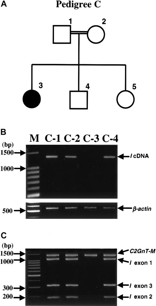 Fig. 4. Deletion of. / I gene in the i member of pedigree C. (A) Pedigree drawing. A sample from C-5 was unavailable in the current study; however, she had been shown to have common I phenotype previously.27 The parents were first cousins. (B) RT-PCR for I cDNA. The expected size of the RT-PCR product ofI cDNA is 1361 bp. Lane M shows the molecular mass standards of the 100-bp ladder. (C) PCR amplifications for the 3 exon regions of the I gene. PCR amplifications for the DNA segments, including I exon 1 (1118 bp), I exon 2 (189 bp), and I exon 3 (321 bp), and C2GnT-M gene (1459 bp), which served as control, were performed separately, and then the 4 products from each person's sample were analyzed in the same lane.