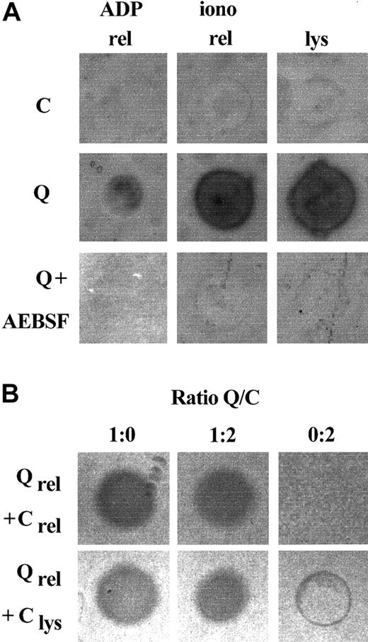 Fig. 1. Fibrinolytic proteases in QPD platelets. / Platelet lysates (lys; 3 μL) and releasates (rel; 3 μL) from patients with QPD (Q) and control subjects (C) were spotted onto fibrin substrate gels. (A) There was abnormal fibrinolytic activity in QPD platelet lysates and releasates that was blocked by the serine protease inhibitor AEBSF. The secretagogue ionophore A23187 (iono) released more of this activity from QPD platelets than ADP. (B) The fibrinolytic enzymes released by QPD platelets were not inhibited in 1:2 mixtures with normal platelet lysates or releasates (tested ratios of patient ionophore releasate–control samples are shown). Protein rings, without evidence of fibrinolysis, were seen in the tests of control lysates.