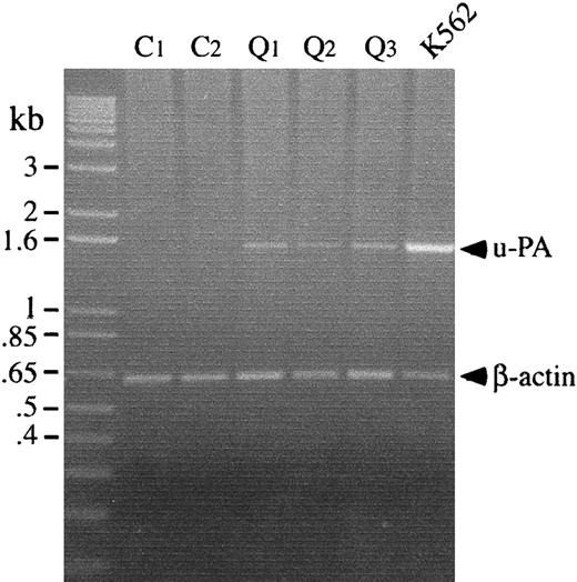 Fig. 5. Platelet u-PA and β-actin mRNA, analyzed by RT-PCR. / u-PA and β-actin transcripts were amplified separately before running the products in lanes of the gel. Lanes compare transcripts amplified from platelets of 2 controls (C) and 3 patients with the QPD (Q), with transcripts from TPA-stimulated K562 cells. QPD platelets contained normal amounts of β-actin mRNA and increased u-PA mRNA, which was not detectable in control platelets.