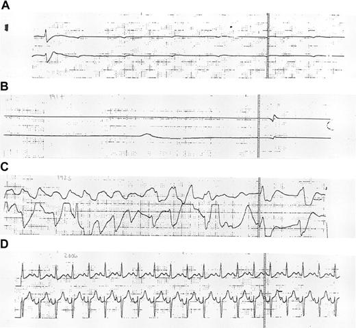 Fig. 2. Electrocardiographic monitoring. / Electrocardiographic monitoring strips obtained during (A-C) and 2 hours after (D) the initial resuscitation of patient 10 are shown.