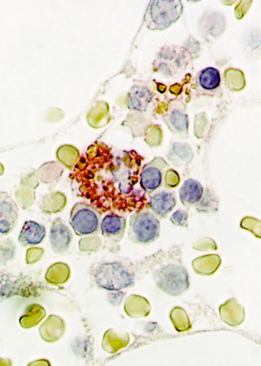Fig. 6. Expression of RCAS1 in the cytoplasm of bone marrow macrophages. / Bone marrow clots were obtained by needle aspiration, then immunohistochemical staining was done using 22-1-1, an anti-RCAS1 antibody. For the second antibody, biotinylated goat F(ab)′2 antimouse IgM antibody, absorbed with human and mouse tissues, was used. A representative analysis of 3 performed from 3 different donors is shown. Note the cytoplasmic staining seen in a macrophage, surrounded by erythroblasts (original magnification, ×1000).