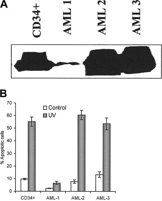 Fig. 9. Apaf-1 expression and the sensitivity to UV light–induced apoptosis in the human AML blasts. / (A) Western blot analysis of the expression of Apaf-1 in human normal CD34+ cells and AML blasts. 50 μg protein was used for Apaf-1 expression. Monoclonal anti–Apaf-1 antibody was used at 1:500 dilution. (B) UV light–induced apoptosis. After exposure to UV light for 5 minutes and further culture for 10 hours, cells were fixed with 4% paraformaldehyde and permeabilized by 0.05% saponin for 20 minutes. Slides were stained with 50 ng/mL DAPI. Apoptotic cells were counted under a fluorescence microscope.