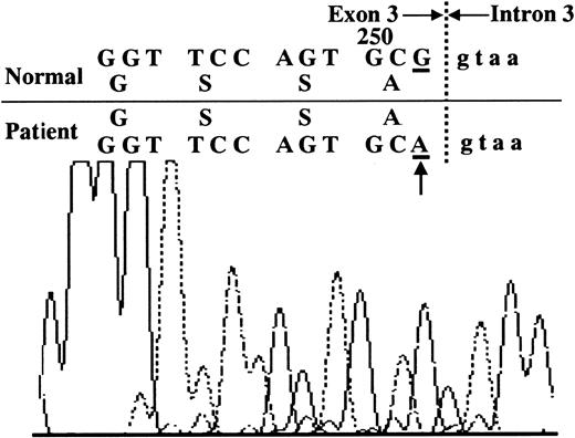 Fig. 2. Mutation in the. / CYBB gene of the CGD patients. A single substitution of adenosine at residue 252 to guanosine was found. This residue is at the 5′ splice site of the third exon/intron boundary (arrow).