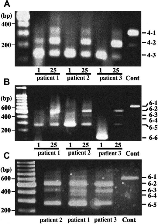 Fig. 6. Splicing pattern change of. / CYBB gene transcripts after IFN-γ treatment.From neutrophil RNA of the patients who received IFN-γ 26 days before, single-stranded cDNAs were synthesized. PCR products were obtained from the cDNAs by using 2 sets of primers, a forward primer on exon 1 and a reverse primer on exon 4 (A) or a forward primer on exon 1 and a reverse primer on exon 6 (B,C). The products were separated on a 3% agarose gel and stained with ethidium bromide. In panels A and B, 40-cycle and in panel C, 50-cycle amplifications were performed. DNA size markers are shown on left and numbers shown on right indicate differently spliced products illustrated in Figure 3.