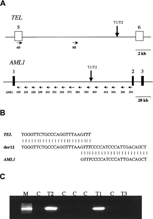 Fig. 1. Analysis of TEL-AML1 translocation in a set of triplet twins. / (A) Scheme of TEL and AML1 genes showing where the primers anneal in both genes (small horizontal arrows). The vertical arrows show the map location of the breakpoint betweenTEL and AML1 shared by the 2 leukemic twins. (B) Sequence neighboring the TEL-AML1 breakpoint found in the twins. The normal TEL sequence is shown at the top, the sequence found in the patients is shown in the center, and theAML1 sequence is shown at the bottom. There is a 4-base homology between TEL and AML1 in the breakpoint, which is shown in italics. (C) PCR analysis of the TEL-AML1translocation on the blood DNA of the triplet twins. The predicted PCR product of 521 bp was amplified with primers A and E in twins T1 and T2 but not in twin T3 or any of the control DNA samples. M, marker; T1 and T2, affected twins; T3, healthy twin; C, negative control DNA samples.