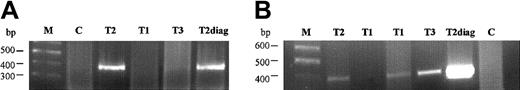 Fig. 2. Analysis of fusion gene sequence in the Guthrie cards of the triplet twins on PCR reactions. / (A, B) First and second PCR reactions, with specific primers B and D amplifying a product of 384 bp. M, marker; T1 and T2, affected twins; T3, healthy twin; C, negative Guthrie controls; T2diag, twin 2 diagnostic DNA.
