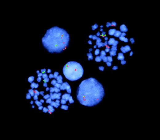 Fig. 3. FISH analysis of TEL-AML1 fusion and TELdeletion. / Representative cells from T1 (2 metaphases, 3 interphases). The lower left-hand metaphase shows 2 normal signals each for TEL(green) and AML1 (red) with no fusion gene (juxtaposition of 2 colors)—ie, a normal, nonleukemic cell. The right-hand metaphase shows a red–green TEL-AML1 fusion plus the normal and the split AML1 signals. In this cell, the green TELsignal (for the nonrearranged TEL allele) is missing (ie, deleted) from the second chromosome 12. The lower interphase cell similarly has TEL-AML1 fusion plus TEL deletion. In contrast, the upper interphase cell has TEL-AML1 fusion but retains the second TEL (green) allele. The middle interphase cell has normal TEL and AML1 signals (note: in this latter, nonleukemic cell, one TEL and oneAML signal are in proximity but are not overlapping or fused).