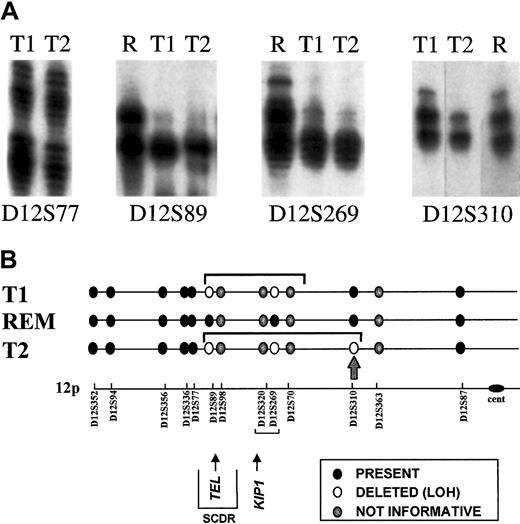 Fig. 4. Analysis of TEL deletions. / (A) Detection of LOH on chromosome 12p. Allotypes at 4 informative markers are shown for each twin pair at diagnosis (T1, T2) and twin 2 at remission (R). Both twins retain heterozygosity of marker D12577 and show LOH at markers D12S89 Δ D12S269. Twin 1 retains heterozygosity at marker D12S310, but twin 2 shows LOH. Deleted alleles are not entirely diminished because of the subclonal deletion of 12p in the leukemic cells. (B) Schematic representation of chromosome 12p showing position of microsatellite markers. The LOH restricted to T2 is shown by the arrow at D12S310. SCDR shows the shortest commonly deleted region.30 REM, remission DNA analysis (no LOH control).