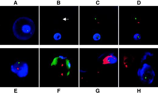 Fig. 2. Simultaneous immunophenotyping and chromosomal FISH. / (A) Primitive ε-positive fetal erythroblast at 10 weeks' gestation stained with AMCA. Cell morphology is well preserved. No DAPI has been used as counterstain because accumulation of AMCA around the nucleus acts as an excellent counterstain. (B-D) Fetal whole blood at 9 weeks' gestation. (B) Use of the Spectrumaqua channel allows the visualization of all heme-containing cells that autofluoresce. One NRBC is positive for ε and the other is negative (arrow); (C) the same group of cells viewed with the red and green filters switched on to show X and Y signals; and (D) the same group of cells viewed with the Spectrumaqua filter off. (E, F) Representative ε-positive and ε-negative cells as seen in a representative mixing experiment of male fetal erythroblasts in never-pregnant adult female nucleated cells in a ratio of 1:10−5. (E) ε-Globin–positive male fetal erythroblast. (F) Nearby ε-globin–negative female nucleated cell. The autofluorescence of the cell through the green channel was deliberately potentiated to demonstrate the outline of the female leukocyte. (G) Mixing experiment of ε-globin–positive male fetal erythroblast with K562 cells cultured in the absence of hemin. One of the X chromosome signals in both neighboring K562 cells are beyond the focal plane captured. (H) Mixing experiment of first trimester, ε-positive, male fetal erythroblasts with female adult bone marrow–derived erythroblasts. Fetal ε-positive NRBC stained with AMCA is clearly distinguished from the AMCA-negative cell. Two X signals are visible in the female erythroblast with demonstrable autofluorescence of heme through red. The Y probe is easily visualized in the male erythroblast, but the X signal is only barely visible at the nuclear periphery in this focal plane. All fluorescence images represent a single optical plane.