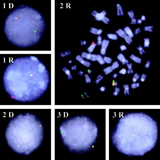 Fig. 1. FISH patterns. / Representative FISH patterns of interphase and metaphase (2R) nuclei were obtained with the TEL (TRITC-labeled; red) andAML1 (FITC-labeled; green) probes in the 3 patients at diagnosis (D) and relapse (R). Most leukemic cells studied at diagnosis of all 3 patients (1D, 2D, and 3D) and at relapse for patient 3 (3R) had a TEL-AML colocalization (yellowish signal) and, as indicated by the missing red signal, a deletion of the secondTEL allele. A different pattern was observed in the relapse samples of patients 1 and 2 (1R and 2R). The signal for the secondTEL allele was clearly present. In addition, 2TEL-AML colocalizations indicated the duplication of the der21 that harbors the relevant gene fusion.