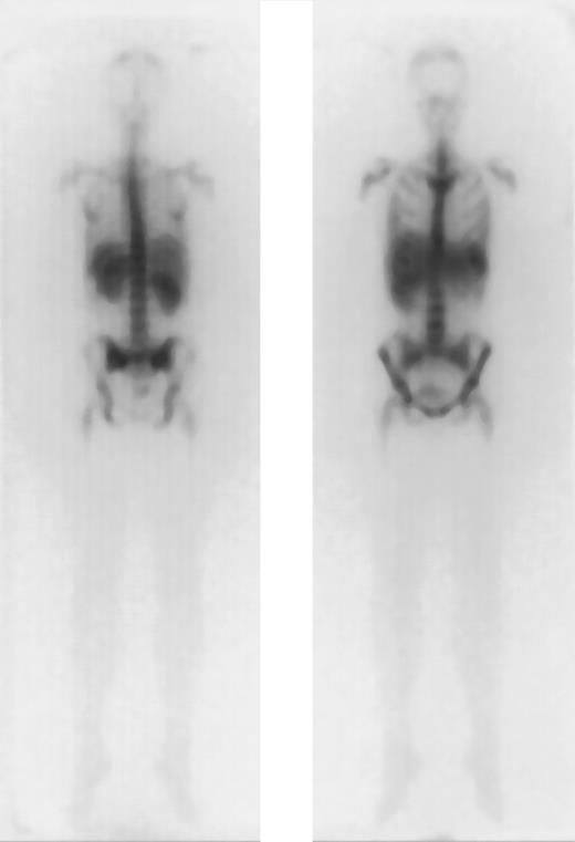 Fig. 1. Favorable dosimetry in a patient with AML in PR (unique patient number 664). / Biodistribution of 1 mg 188Re-labeled anti-CD66 monoclonal antibody after 40 hours, in anteroposterior and posteroanterior projection.