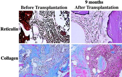 Fig. 2. Reticulin and trichrome staining for marrow fibrosis in patient 01-004 before and 9 months after transplantation.
