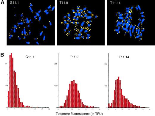 Fig. 4. Telomere analysis of transduced T-cell clones. / (A) Q-FISH analysis of metaphase chromosomes isolated from subclones transduced with the GFP vector (G11.1, second cloning step) and the TERT/GFP vector (T11.9 and T11.14, sixth cloning step). DAPI-stained chromosomes and Cy-3–labeled telomeres are shown in blue and yellow, respectively. (B) Distribution of TFUs in metaphase chromosomes from subclones transduced with GFP vector (G11.1) and TERT/GFP vector (T11.9 and T11.14). The average telomere fluorescence at individual chromosome ends was calculated to be 4.3 TFU for G11.1, 11.5 TFU for subclone T11.9, and 8.9 TFU for subclone T11.14. These values correspond closely to estimates of the average telomere length in these cells obtained by flow FISH (respectively 10.9, 21.7, and 14.9 kMESF units corresponding to an estimated18 5.4, 10.9, and 7.5 kb of telomere repeats for G11.1, T11.9, and T11.14 cells).