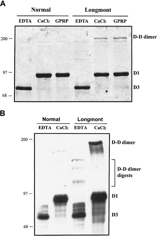 Fig. 3. Fibrinogen Longmont is protected by both GPRP peptide and calcium ions against further digestion by plasmin. / Normal fibrinogen and fibrinogen Longmont (0.2 mg/m) were digested with 10 μg/mL plasmin in the presence of 5 mM EDTA, 5mM CaCl2, or 2 mM GPRP peptide. The plasmin digests were analyzed on 7.5% SDS-PAGE in nonreduced conditions. (A) The gel was stained with Coomassie brilliant blue. (B) A Western blot of the plasmin digests in the presence of 5 mM EDTA or 5mM CaCl2 using a polyclonal antibody to human fibrinogen.