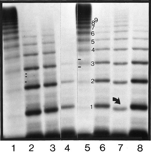 Fig. 1. Autoradiograph of plasma vWF:Ag multimers of the affected members of families 1, 2, and 3. / Plasma samples electrophoresed in a 1.8% SDS-agarose gel and visualized by sodium iodide 125–labeled anti-vWF:Ag monoclonal antibody showing the abnormal multimer band patterns in F1-P1, F1-P2, F1-P3, F2-P1, and F3-P1 in lanes 2, 3, 4, 6, and 7, respectively. A type IID phenotype international reference plasma1119 is shown in lane 8, and 2 normal plasmas are shown in lanes 1 and 5. The direction of electrophoresis is from top to bottom. The arrow in lane 7 indicates the faster migrating central band 1 in F3-P1. Differences in the minor satellite bands between normal and IID plasma (2 bands in normal and 3 bands in IID plasma) are shown in lanes 2 and 5, respectively.