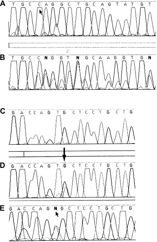 Fig. 2. DNA sequence analysis of exons 51 and 52 of the. / VWF gene in WT and affected members of families 1, 2, and 3. Panel A shows the WT sequence of exon 51 from T8434 to T8457, with an arrow indicating nt 8437 where the deletion begins in patient F3P1. Panel B shows the DNA sequence of the patient from family 3, with a series of superimposed bases as a result of the heterozygous deletion beginning at position 8437. Panels C to E show the sequence of exon 52 from nucleotide 8555 to 8571. Panel C shows the WT sequence. Panel D shows the sequence from one affected member from family 1, with a heterozygous G8562A transition. Panel E shows the sequence from patient F2P2, showing a T8561A transversion.