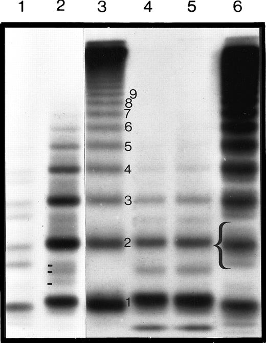 Fig. 4. Autoradiograph of the multimeric analysis of plasma and rVWF from COS-7 cells after transfection with WT or type IID vWF cDNA. / The autoradiograph shows plasma and rVWF samples electrophoresed on a high-resolution 1.8% SDS-agarose gel and visualized by autoradiography. Electrophoresis is from top to bottom and shows the high-, intermediate-, and low-molecular-weight multimers, together with the triplet structure of each of the multimer bands. Normal plasma is shown in lane 6, typical type IID vWD plasma in lane 2, and type IIA vWD plasma in lane 1. Wild-type rVWF, C2008S rVWF, and C2008Y rVWF are in lanes 3, 4, and 5, respectively. The bracket indicates the triplet structure of the second major multimer band, and different minor satellite bands (2 in normal and 3 in IID plasma) are also indicated. Note that no minor satellite bands can be seen in the WT rVWF.