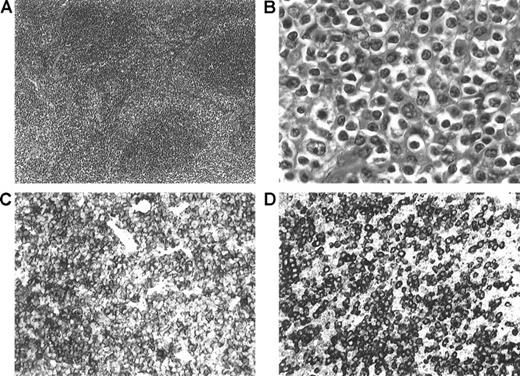 Fig. 2. Morphologic and immunophenotypic features of nodal MZL. / (A) Low-power view showing a parafollicular/perisinusoidal distribution of the neoplastic cells that surround some residual B-cell follicles (hematoxylin and eosin staining (H&E), × 100). (B) High-power view showing marginal zone/monocytoid B cells with medium-sized round (to irregular) nuclei and abundant pale cytoplasm (H&E, × 100). (C) CD20 staining showing strong positivity of the neoplastic cells (× 400). (D) Immunostaining for IgM, showing strong surface staining of the neoplastic lymphocytes (× 400).