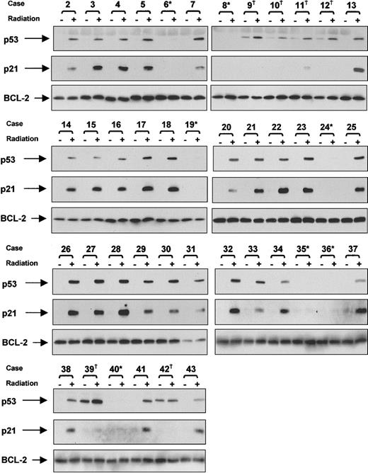 Fig. 2. Detection of p53 dysfunction. / Irradiated and nonirradiated CLL cells were lysed after 10-hour culture. Protein extracts were subjected to SDS-PAGE and Western blot analysis, as described in “Patients, materials, and methods.” After initially probing for p21, membranes were sequentially stripped and reprobed for p53. To take into account any differences in protein loading, membranes were stripped again and reprobed for BCL-2. Dagger and asterisk denote patients with CLL showing types A and B p53 dysfunction, respectively.