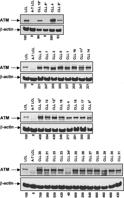 Fig. 4. Relation between ATM levels and p53 dysfunction. / ATM and β-actin levels were measured by Western blot analysis in 31 patients with CLL. Normal and A-T lymphoblastoid cell lines (LCL) were used as positive and negative controls, respectively. β-Actin and central ATM bands were quantified by densitometry, and the ATM:β-actin ratio of each lane was calculated. To enable comparisons to be made between individual membranes, the ATM:β-actin ratios were normalized with respect to the control cells on the same membrane. Dagger and asterisk denote patients with types A (patients 9, 10, 11, 12) and B (patients 6, 8, 19, 24) p53 dysfunction, respectively. The Figure shows the results obtained using the FP8r antibody, but similar results were obtained with AHP397.