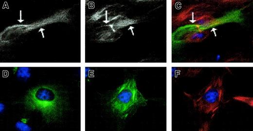 Fig. 2. GFP-pyrin localizes with microtubules in untreated and paclitaxel-treated cells. / HeLa cells were transfected with pEGFP-MEFV.N plasmid and immunostained with anti–β-tubulin and Cy3 conjugated goat anti–mouse IgG. (A) A transfected cell without paclitaxel treatment has a filamentlike GFP pattern. (B) Microtubule staining of the same cell. (C) Merge of GFP and microtubule staining demonstrating colocalization of GFP and microtubule staining. Arrows indicate regions where staining overlap is particularly noticeable. (D) A transfected cell with strong perinuclear GFP signal. (E) GFP-pyrin and (F) microtubule staining of a paclitaxel-treated transfected cell in which colocalization is extensive. Magnification × 1000.