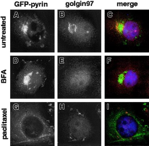 Fig. 3. Pyrin and anti–golgin-97 labeling do not overlap in transfected Cos-7 cells. / Cos-7 cells were transfected with pEGFP-MEFV.N plasmid and Golgi was labeled with rabbit anti–golgin-97 serum, followed by Cy3-conjugated donkey anti–rabbit IgG. Nuclei were stained with DAPI. Cells were examined by epifluorescence microscopy. (A,D,G) GFP-pyrin and (B,E,H) anti–golgin-97 staining in untreated, BFA-treated, and paclitaxel-treated cells, respectively. (C,F,I) Merged anti–golgin-97 and GFP-pyrin fluorescence images. Magnification × 1000.
