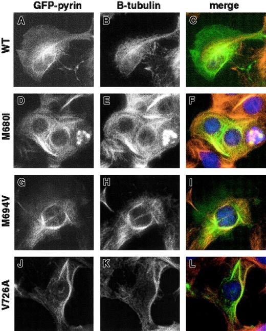 Fig. 4. Effect of FMF-associated mutations on the ability of pyrin to localize with microtubules. / HeLa cells transfected with GFP-pyrin plasmid encoding 3 of the most common FMF mutations were treated with 10 μM paclitaxel before fixing. (A,D,G,J) GFP-pyrin; (B,E,H,K) staining with mouse anti–β-tubulin and Cy3-conjugated goat anti–mouse IgG; (C,F,I,L) merged images of panels A and B, D and E, G and H, and J and K, respectively. (A-C) Cells transfected with wild-type pyrin; (D-F) pyrin with M680I mutation; (G-I) pyrin with M694V mutation; (J-L) pyrin with V726A mutation. Magnification × 1000.