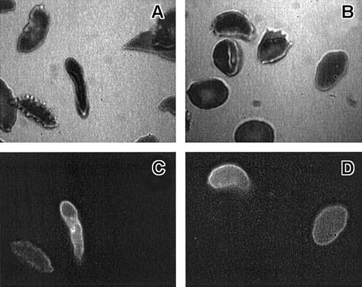 Fig. 3. Morphology of AV-binding sickle cells. / Bright-field (panels A, B) and epi-fluorescence (panels C, D) micrographs of the same RBCs from a high-density (1.13 g/mL or greater) (panels A, C) or low-density (less than 1.08 g/mL) (panels B, D) sickle cell population. ISCs are defined as cells that are elongated with length 2 or more × width.