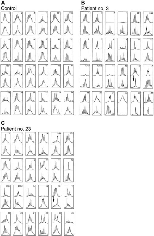 Fig. 4. Changing in CDR3 size patterns associated with autologous GVHD before ASCT (upper) and day 26 after ASCT at the onset of autologous GVHD (lower). / CDR3 size patterns of PBLs in the patients who did not receive CsA (control; panel A) and those in whom autologous GVHD developed (patients 3 and 23; panels B and C, respectively).