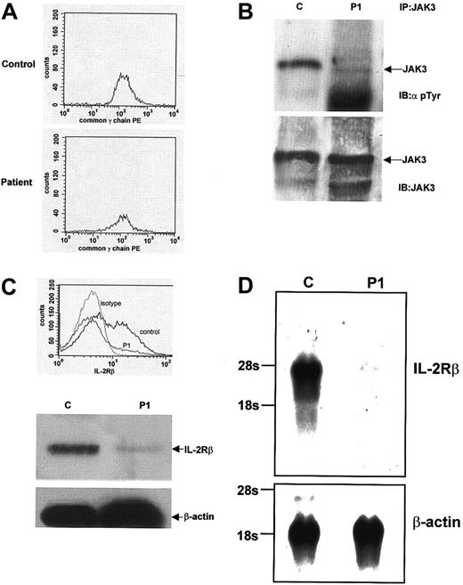 Fig. 1. IL-2 signaling and IL-2R/IL-15Rβ expression abnormalities in T↓B+NK− SCID. / (A) Flow cytometric analysis of PBMCs for cell surface expression of γc. Equivalent amounts of γc expression are seen in both a control sample and sample from P1. (B) Tyrosine phosphorylation of JAK-3 after IL-2 stimulation. PBMCs from a control and P1 were stimulated with IL-2, lysed, and immunoprecipitated using an anti–JAK-3 antibody. JAK-3 immunoprecipitates were then immunoblotted using an antiphosphotyrosine antibody. Normal JAK-3 tyrosine phosphorylation is seen in the control sample, but only minimal tyrosine phosphorylation is seen in P1 (top panel). The filter was stripped and reblotted with an anti–JAK-3 antibody, and the blot shows equivalent amounts of JAK-3 expression in both samples (bottom panel). (C) Flow cytometric and Western blot analysis of IL-2R/IL-15Rβ expression. PBMCs from a control and P1 were analyzed by flow cytometry for cell surface expression of IL-2R/IL-15Rβ. Normal expression is seen in a control sample, but significantly decreased expression is seen in the sample from P1. Western blot analyses of whole cell lysates from a control and P1 also show decreased expression of IL-2R/IL-15Rβ. Stripping the filter and reblotting with an anti–β-actin antibody shows equivalent protein loading in each lane. (D) Northern blot analysis ofIL-2R/IL-15Rβ expression. mRNA prepared from PBMCs from a control subject and from P1. Northern blot analysis using anIL-2R/IL-15Rβ cDNA probe shows 7% of control IL-2R/IL-15Rβ expression in the sample from P1. Equivalent mRNA loading was demonstrated after stripping and reblotting the filter with a probe for β-actin.