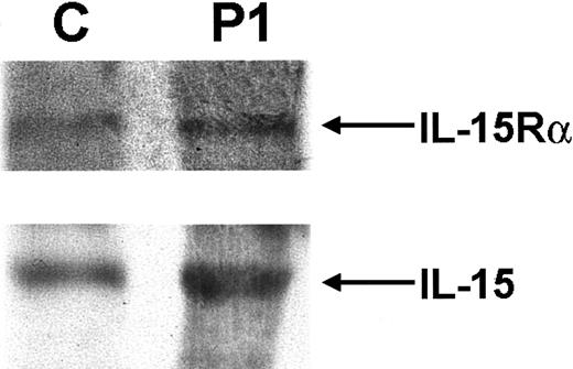 Fig. 2. IL-15Rα and IL-15 expression. / Western blot analysis of IL-15Rα and IL-15 expression in PBMCs of P1 shows expression equivalent to that seen in a normal control.