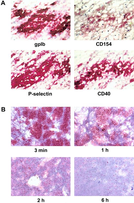 Fig. 6. Expression levels of gpIb, P-selectin, CD154, and CD40 on platelets in human thrombi. / (A) Expression of CD154 and other platelet markers in intravitally formed thrombi. Consecutive serial cryostat sections of fresh venous thrombi were immunostained for the platelet-specific marker gpIb, the activation marker P-selectin, CD154, and CD40 by the APAAP technique. Shown is a characteristic result. (B) Time course of CD154 expression in thrombi generated in vitro. Thrombi were generated by addition of 0.2 U/mL thrombin to PRP and vortexing. After the indicated time periods, the thrombi were snap-frozen, and consecutive sections were immunostained for the expression of CD154 and other platelet markers. Signal obtained for CD154 is shown at 3 minutes, 1 hour, 2 hours, and 6 hours using the tyramide amplification system. The immunostaining patterns of gpIb, P-selectin, and CD40 did not change significantly over the time examined (not shown). In all experiments, counterstaining was performed with hematoxylin; original magnification was 600 ×.