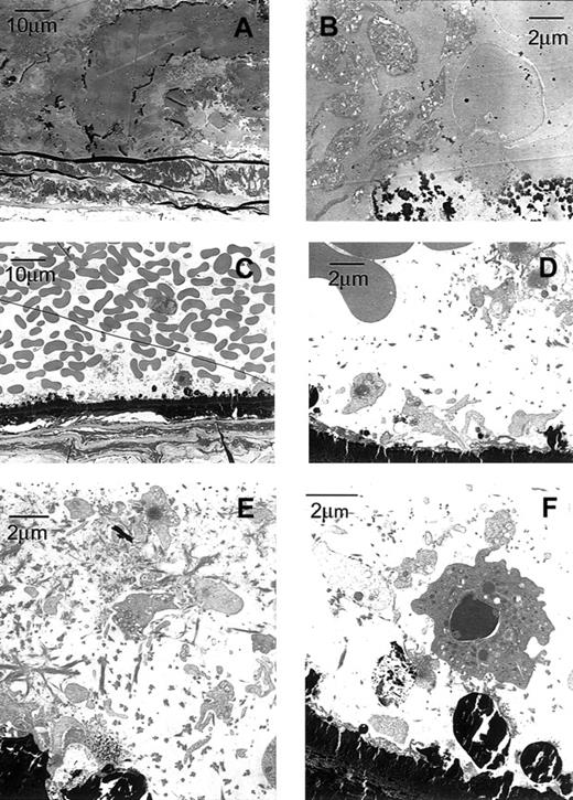 Fig. 4. Transmission electron micrographs of a carotid artery from a β3+/+ and a β3−/− mouse exposed to FeCl3 demonstrate platelet masses in the β3+/+ mouse and a platelet monolayer in the β3−/− mouse. / The carotid artery of the β3+/+ mouse (A-B) was fixed approximately 7 minutes after the application of FeCl3, whereas the artery in the β3−/− mouse (C-F) was fixed after 30 minutes. Dark-staining FeCl3 accumulated along the internal elastic lamina and, in the wild-type artery, within the thrombus. The vessel in the wild-type mouse was occluded by thrombus composed of platelets, fibrin, and erythrocytes (A-B). Primarily a single layer of platelets adhered to FeCl3-treated vessel wall of the in β3−/− mouse (C-D); fibrin and residual erythrocytes were also present. In addition to attaching directly to the damaged wall, platelets accumulated in areas rich in fibrin along the β3−/− artery (E). Along the damaged vessel in β3−/− mouse, adherent platelets recruited leukocytes, and additional platelets attached to the luminal surfaces of the leukocytes (F).